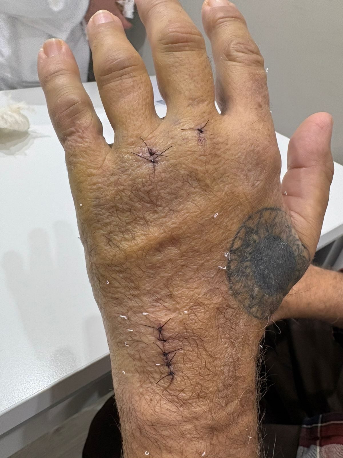 El músico Javier Malosetti enfrenta un difícil proceso de recuperación tras un accidente que le fracturó la mano.