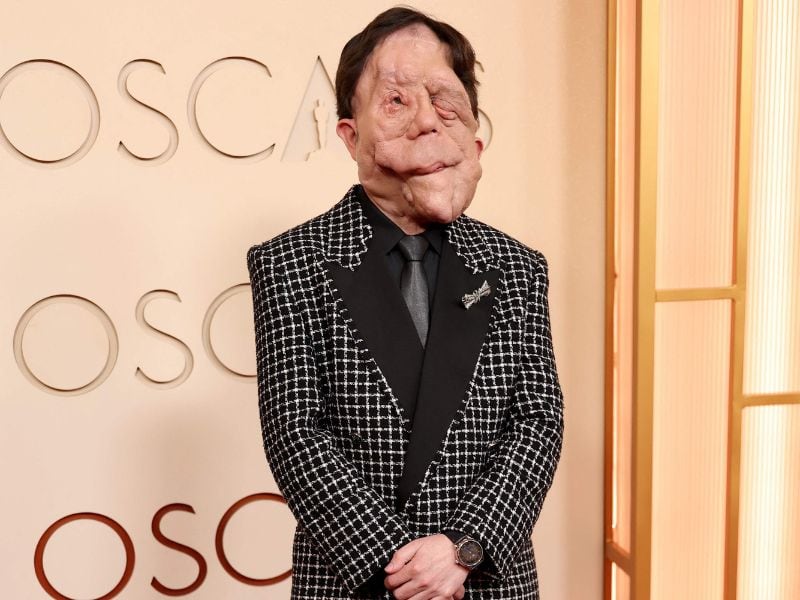 Conoce la neurofibromatosis tipo 1, la condición que padece el actor Adam Pearson.