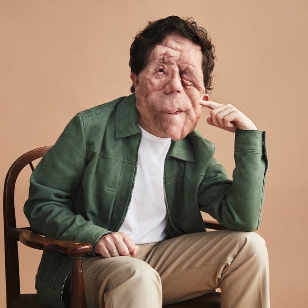 Conoce la neurofibromatosis tipo 1, la condición que padece el actor Adam Pearson.